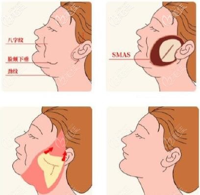 面部微创悬吊提升术操作步骤