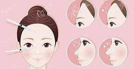 汤芳芳医生在玻尿酸填充方面的优势 汤芳芳医生在玻尿酸填充方面的优势