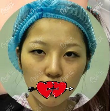 找武汉涵美冯晓玲割双眼皮术前照片 找武汉涵美冯晓玲割双眼皮术前照片