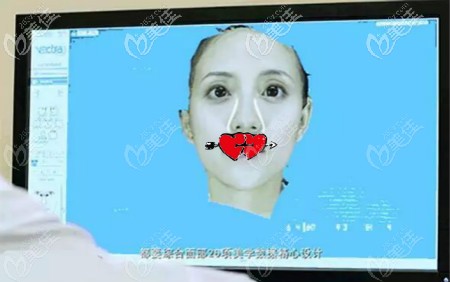 武汉涵美冯晓玲院长给我割双眼皮术前电脑模拟效果