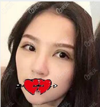 武汉涵美冯晓玲割双眼皮术后第7天效果 武汉涵美冯晓玲割双眼皮术后第7天效果