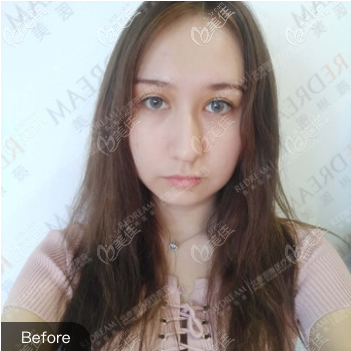 在<!--<i data=20240703-sp></i>-->做双眼皮局部调整修复前 在<!--<i data=20240703-sp></i>-->做双眼皮局部调整修复前