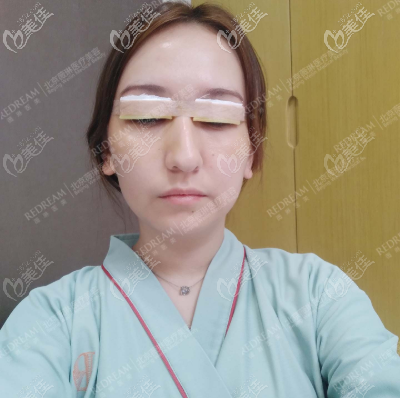 薇琳董香君给我做双眼皮修复术后头一日