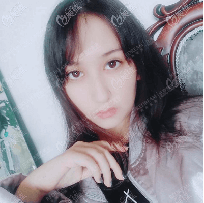 <!--<i data=20240703-sp></i>-->董香君双眼皮修复案例 <!--<i data=20240703-sp></i>-->董香君双眼皮修复案例