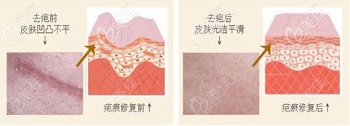 唇腭裂激光去疤图片原理