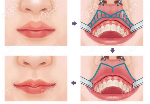 包头叶子厚唇变薄手术原理和效果