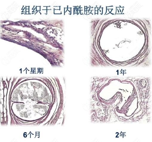 阿普托斯德国埋线提升线材的吸收时间 阿普托斯德国埋线提升线材的吸收时间