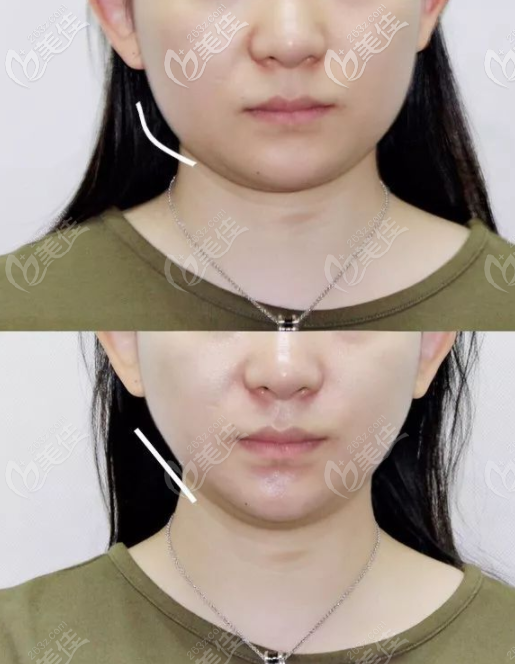 沈阳伊美尔热玛吉下颌缘提升对比效果