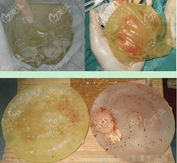 假体包膜挛缩和剥离的样子