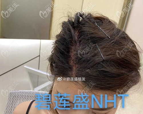 NHT不剃发植发技术术后即刻效果 NHT不剃发植发技术术后即刻效果