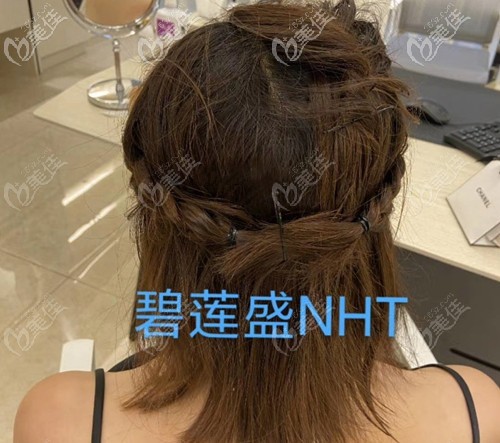 女士头顶加密后枕部不剃发效果图 女士头顶加密后枕部不剃发效果图