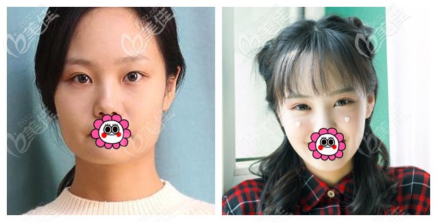 沈阳杏林朱石江下颌角案例 沈阳杏林朱石江下颌角案例