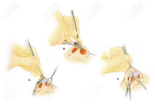 翟彦刚擅长做鼻综合手术 翟彦刚擅长做鼻综合手术