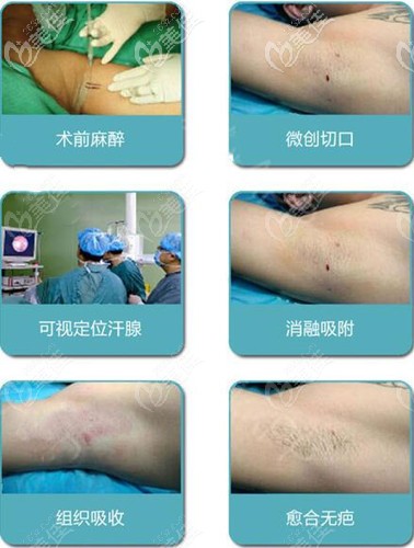 深圳军科治疗腋臭郭晨 深圳军科治疗腋臭郭晨