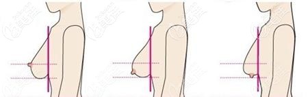 正常胸型和下垂的胸型对比