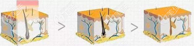 激光脱毛作用原理示意图
