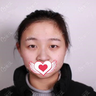 割双眼皮术前照 割双眼皮术前照