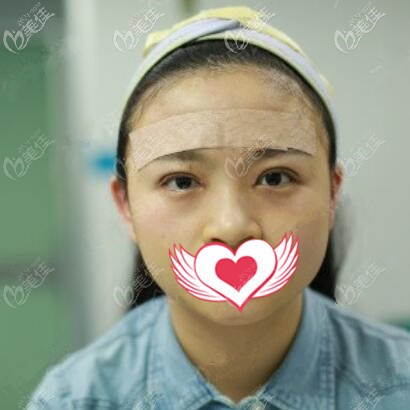 割双眼皮开眼角术后即刻效果照 割双眼皮开眼角术后即刻效果照