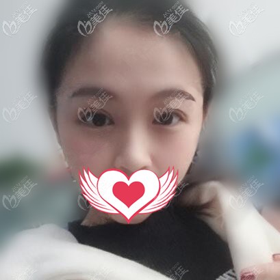 做双眼皮眼综合术后一周的效果照 做双眼皮眼综合术后一周的效果照