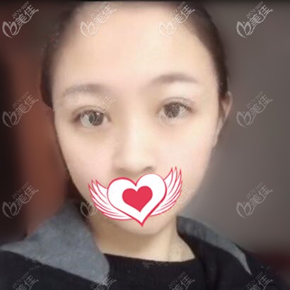 做眼综合术后半个月的恢复效果照 做眼综合术后半个月的恢复效果照