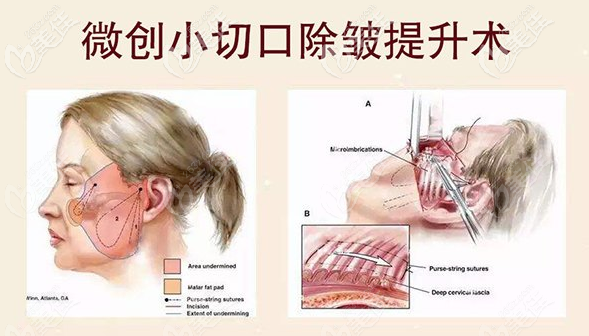 微创小切口除皱术 微创小切口除皱术