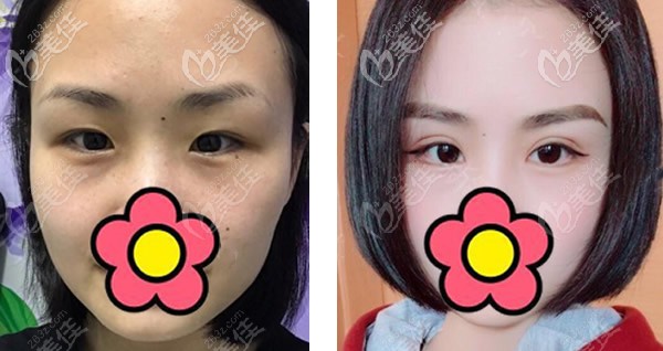 内双可以割双眼皮吗 内双可以割双眼皮吗