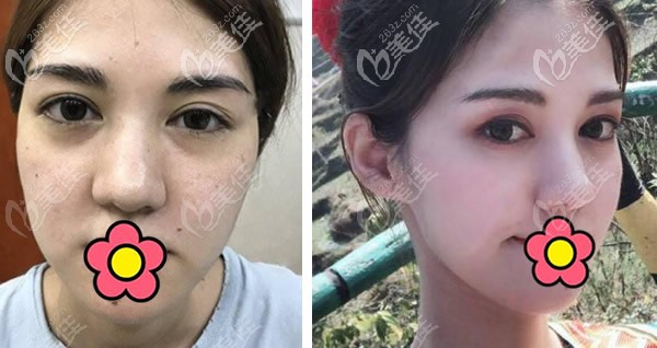 兰州韩美歪鼻矫正+激光祛斑效果图 兰州韩美歪鼻矫正+激光祛斑效果图