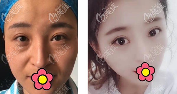 兰州韩美阳赞生内切去眼袋+全脸脂肪填充三个月恢复图 兰州韩美阳赞生内切去眼袋+全脸脂肪填充三个月恢复图