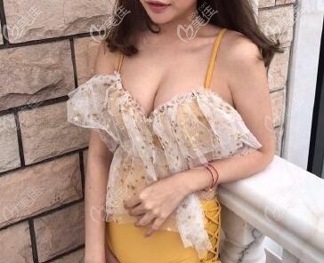 做假体隆胸后填充自体脂肪半年效果图 做假体隆胸后填充自体脂肪半年效果图