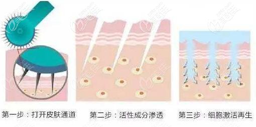 微针治疗黑眼圈的原理过程示意图 微针治疗黑眼圈的原理过程示意图