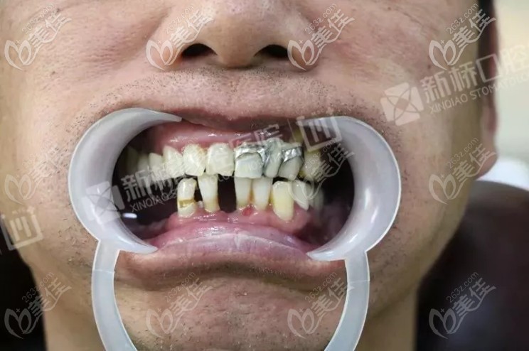 术前牙齿情况 术前牙齿情况