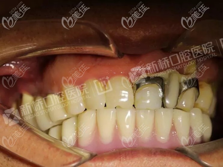  口腔下半口种6颗即刻负重种植牙的案例来啦