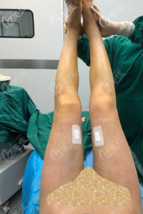 罗<!--<i data=20240703-sp></i>-->医生刚给我做完手术