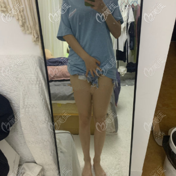 重庆好美罗<!--<i data=20240703-sp></i>-->大腿吸脂术后一个月