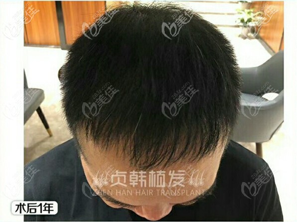 我知道了自己大面积脱发原因后,选择在柳州贞韩植发找回自信