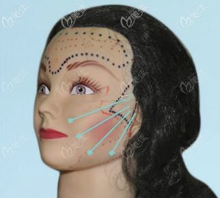 面部微创悬吊提升埋线位置图解