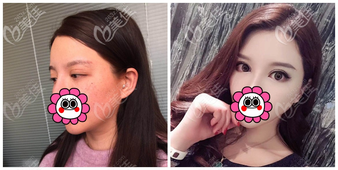 假体垫眉弓效果对比图