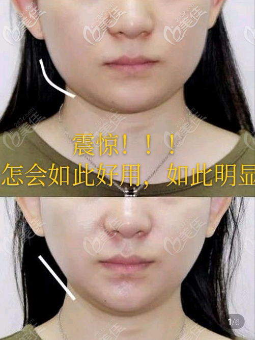 热玛吉做下颌线多少钱提升下颌缘只做热玛吉下颌线有用吗