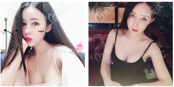 感觉佛山美莱曾昂丰胸技术特别好