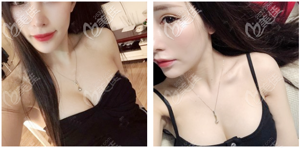 佛山美莱曾昂丰胸案例一个月效果图