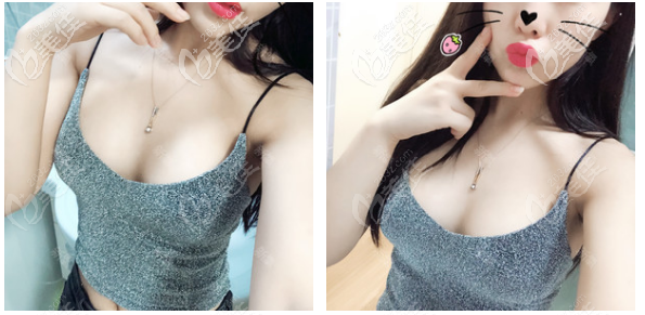 佛山美莱曾昂丰胸术后12天反馈