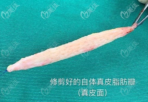 自体真皮瓣组织