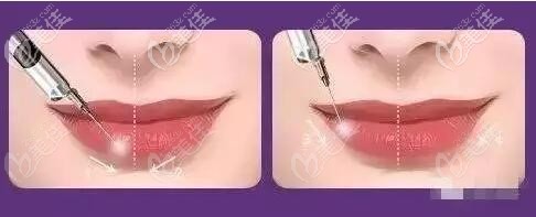 玻尿酸丰唇位置