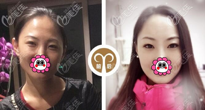 不开刀缩下颌角效果