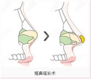 短鼻延长图