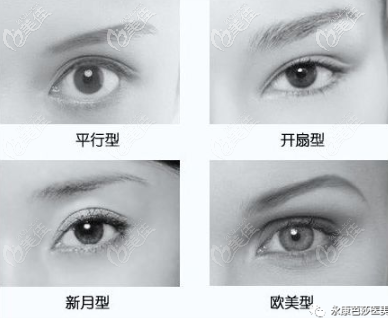 永康芭莎双眼皮类型
