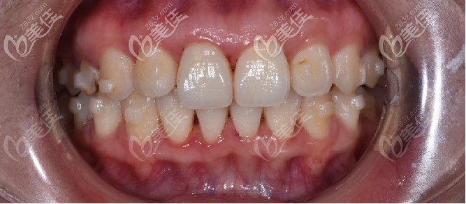 牙齿天包地做隐适美矫正效果图流出,这变化你爱了吗