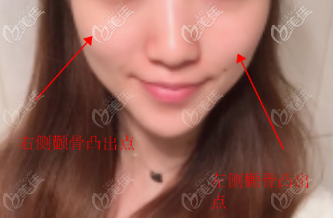 右侧颧骨比左侧颧骨凸出0.5公分