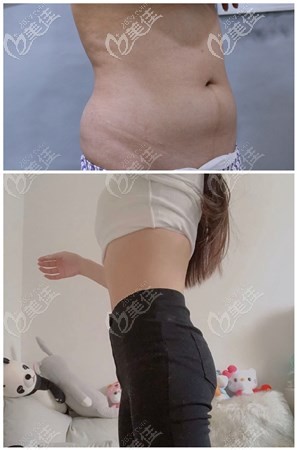 青岛华颜美张庆吸脂案例 青岛华颜美张庆吸脂案例