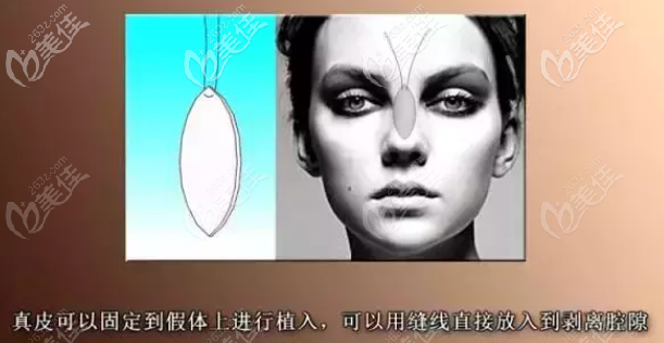 自体真皮隆鼻材料